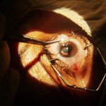 Decoding Cataract Removal: What You Need to Know About Your Surgery Options