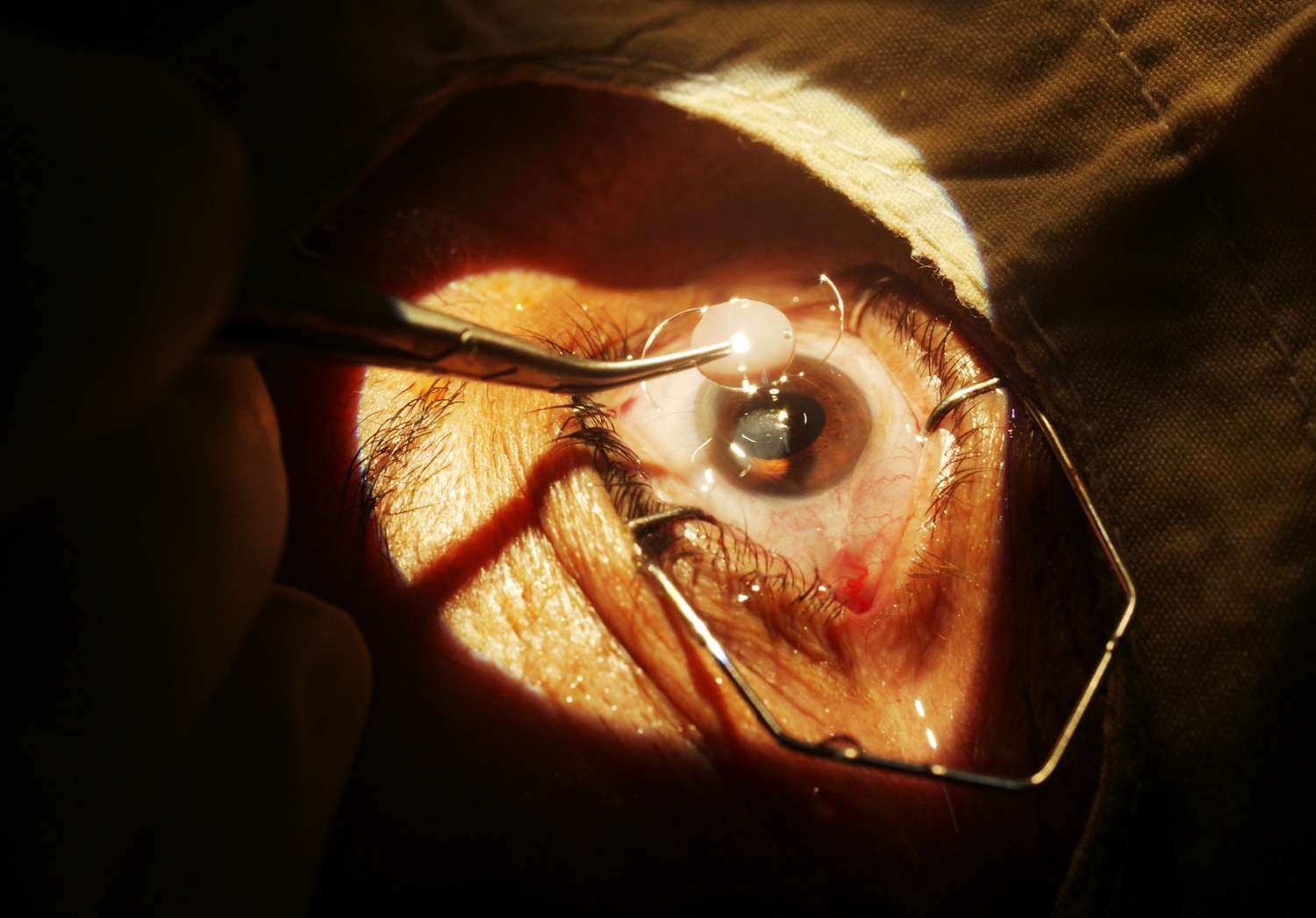 Decoding Cataract Removal: What You Need to Know About Your Surgery Options